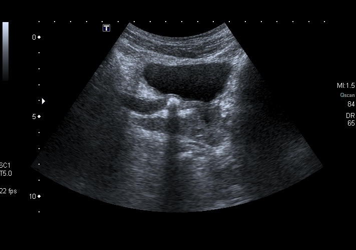 File:Obstructive uropathy and urolithiasis on ultrasound (Radiopaedia 25562-25758 F 1).jpg