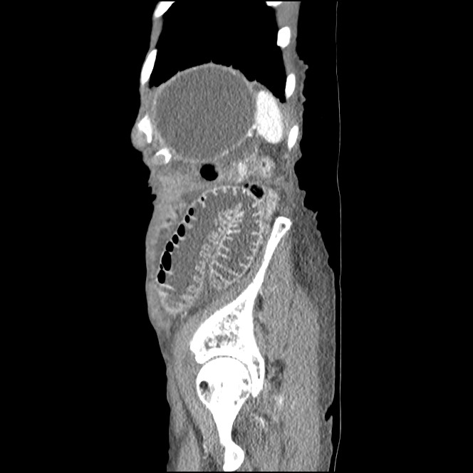 Obturator hernia causing small bowel obstruction (Radiopaedia 65522-74612 C 14).jpg