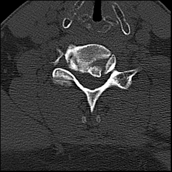 Occipital condyle fracture (type 1) (Radiopaedia 87670-104084 Axial bone window 62).jpg