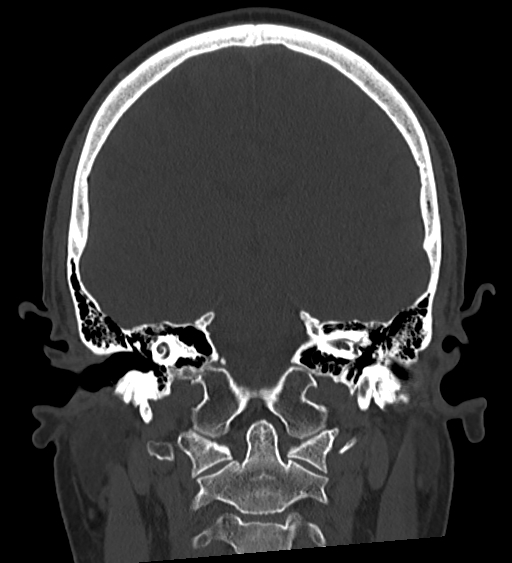Occipital spur and Currarino type A atlas anomaly (Radiopaedia 87027-103285 Coronal bone window 88).jpg