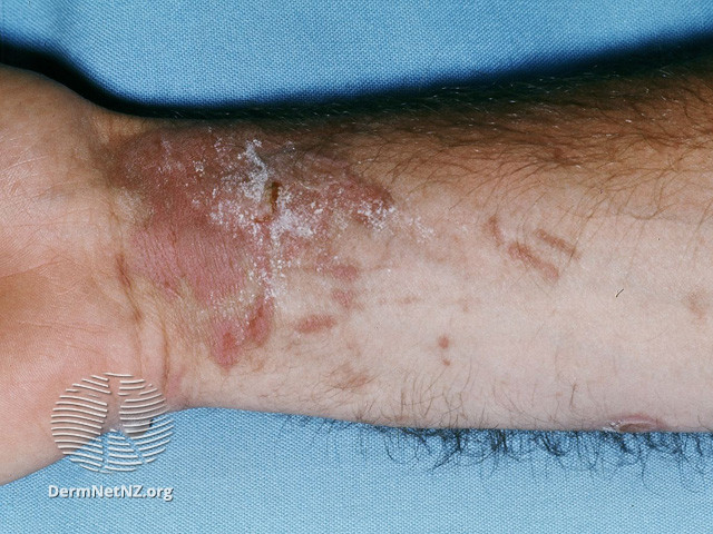 File:Pigmentary phytophotodermatitis (DermNet NZ dermatitis-plants-phytophotodermatitis-4).jpg