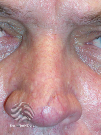 File:Telangiectasia (DermNet NZ acne-rosacea6).jpg