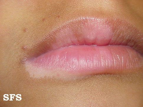 File:Vitiligo (Dermatology Atlas 16).jpg