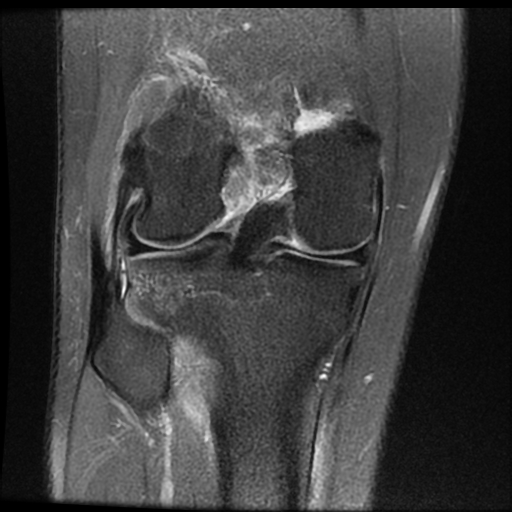 File:ACL acute full thickness tear - deep lateral femoral sulcus sign (Radiopaedia 38594-40740 Coronal PD fat sat 14).jpg