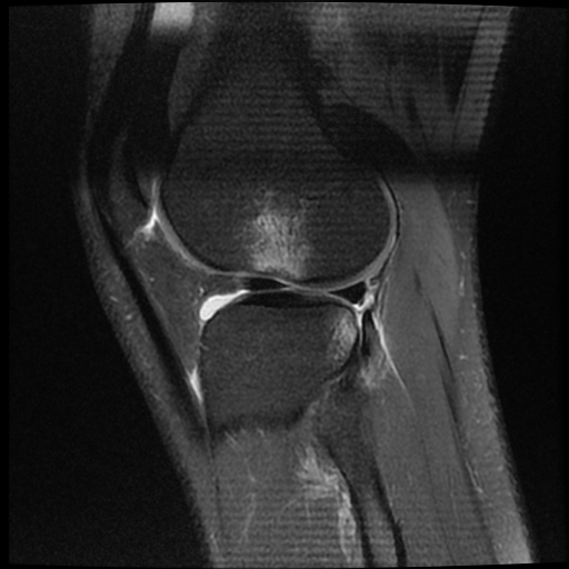 File:ACL acute full thickness tear - deep lateral femoral sulcus sign (Radiopaedia 38594-40740 Sagittal PD fat sat 17).jpg