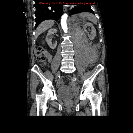 Abdominal aortic aneurysm- extremely large, ruptured (Radiopaedia 19882-19921 Coronal C+ arterial phase 64).jpg