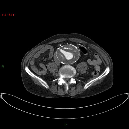 File:Abdominal aortic aneurysm (Radiopaedia 16155-15834 Axial C+ arterial phase 24).jpg