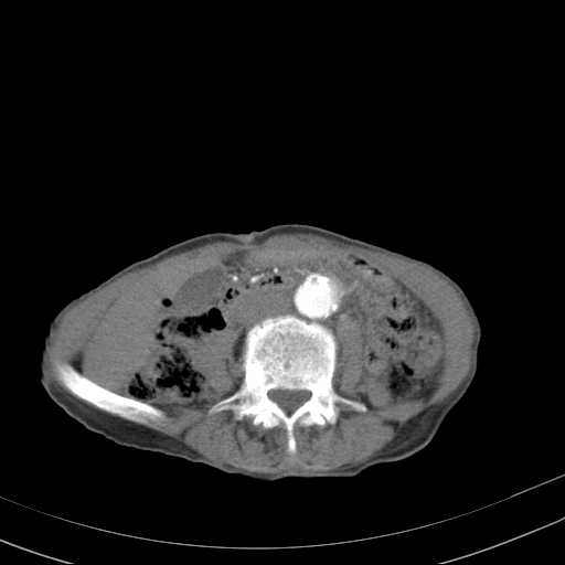 File:Abdominal aortic aneurysm (Radiopaedia 20827-20742 Axial C+ arterial phase 20).jpg