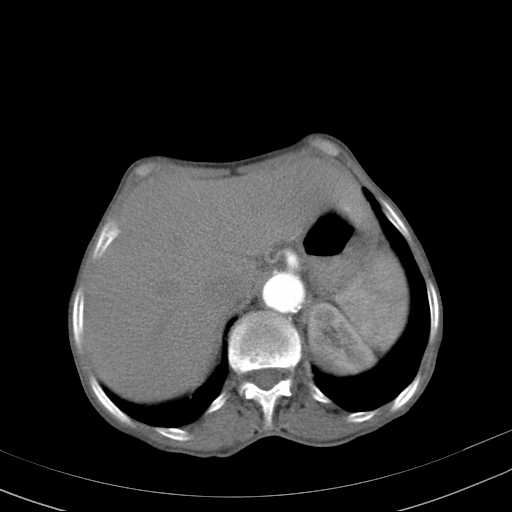 File:Abdominal aortic aneurysm (Radiopaedia 20827-20742 Axial C+ arterial phase 7).jpg