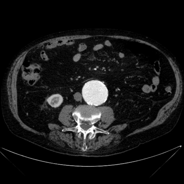 Abdominal aortic aneurysm (Radiopaedia 25855-26001 Axial C+ arterial phase 71).jpg