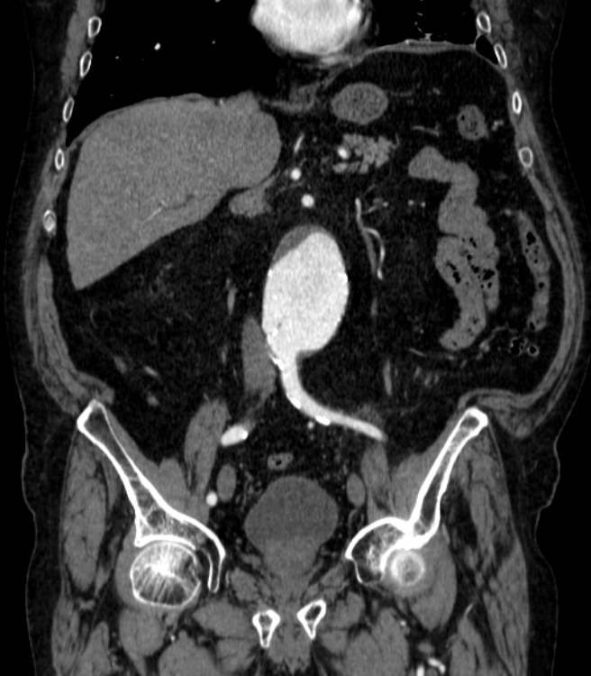 Abdominal aortic aneurysm (Radiopaedia 25855-26001 Coronal C+ arterial phase 29).jpg