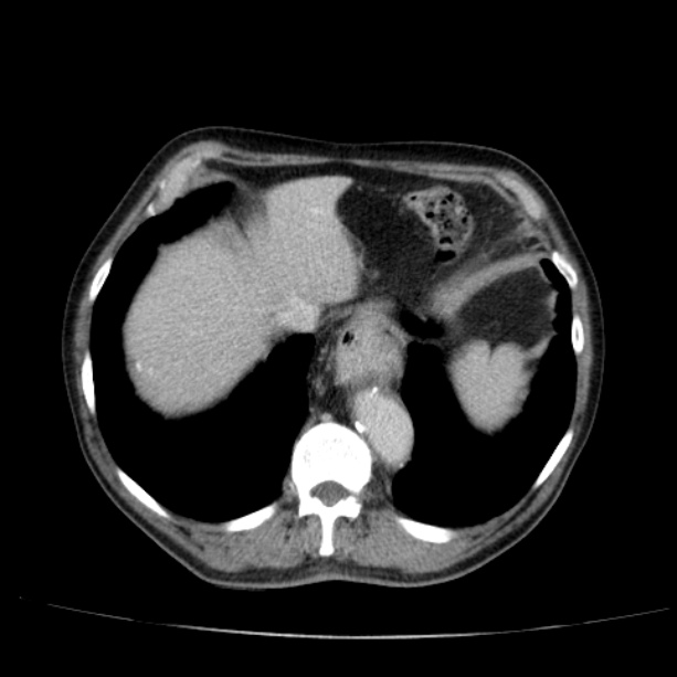 Abdominal aortic aneurysm (Radiopaedia 29248-29660 Axial C+ portal venous phase 10).jpg