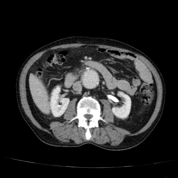 Abdominal aortic aneurysm (Radiopaedia 29248-29660 Axial C+ portal venous phase 28).jpg