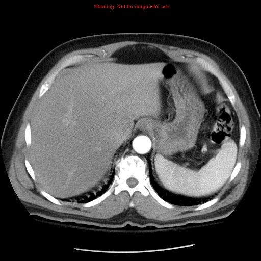 Abdominal aortic aneurysm (Radiopaedia 8190-9038 Axial C+ arterial phase 14).jpg