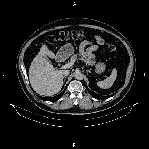 Abdominal aortic aneurysm (Radiopaedia 83094-97462 Axial renal excretory phase 35).jpg