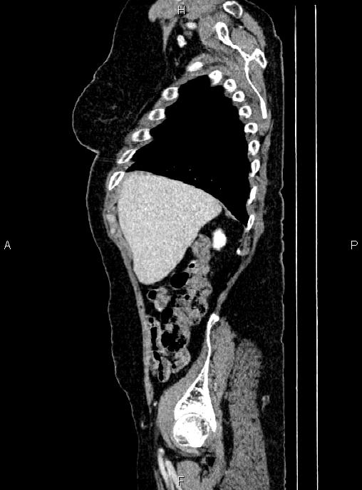 Abdominal aortic aneurysm (Radiopaedia 85063-100606 Sagittal C+ arterial phase 12).jpg