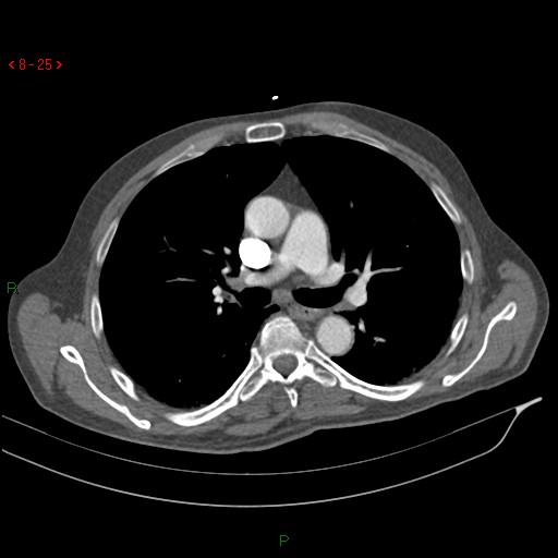 Abdominal aortic aneurysm rupture with aortocaval fistula (Radiopaedia 14897-14841 Axial C+ arterial phase 25).jpg