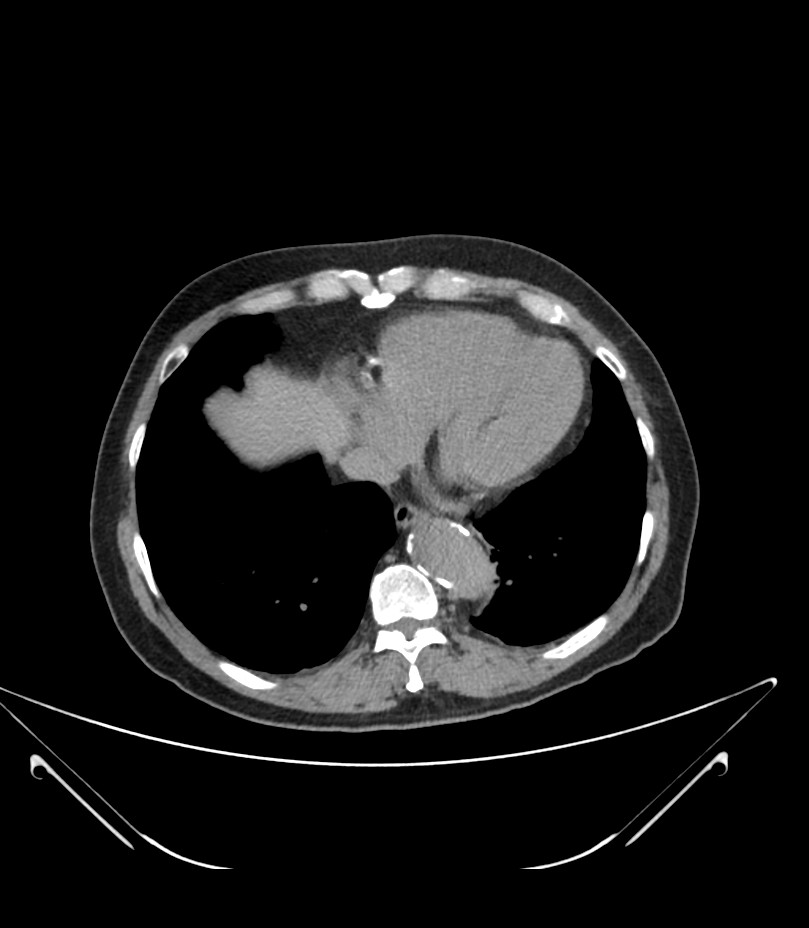 Abdominal aortic aneurysm with thrombus fissuration (Radiopaedia 46218-50618 Axial non-contrast 3).jpg