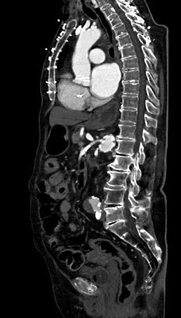 Abdominal aortic aneurysm with thrombus fissuration (Radiopaedia 73192-83919 Sagittal C+ arterial phase 65).jpg