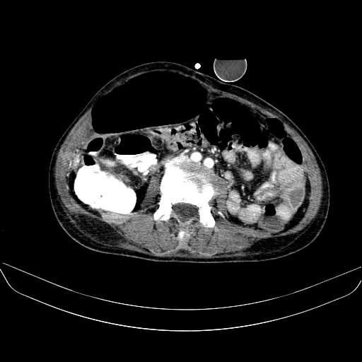 File:Abdominal collection due to previous cecal perforation (Radiopaedia 80831-94320 Axial C+ portal venous phase 113).jpg