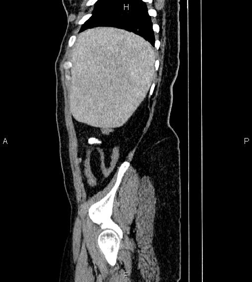 File:Abdominal lymphoma with sandwich sign (Radiopaedia 84378-99704 Sagittal C+ portal venous phase 80).jpg
