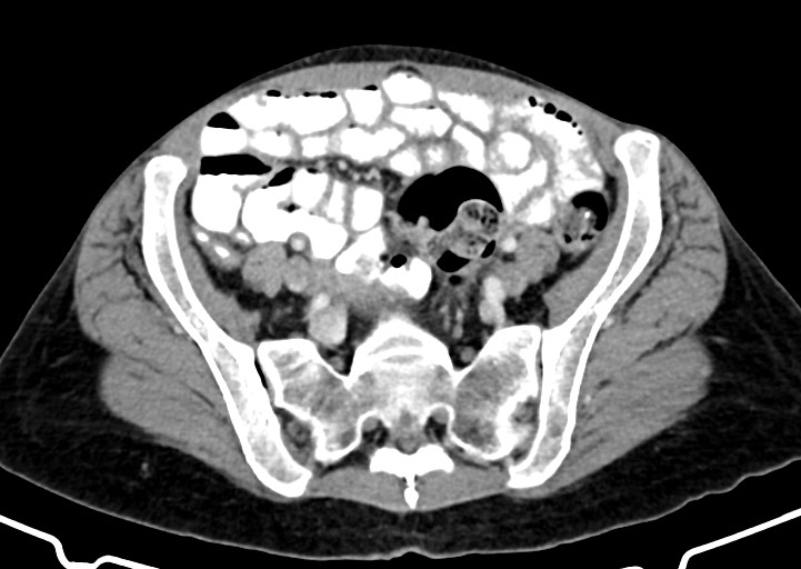 Abdominal wall and retroperitoneal tuberculosis (Radiopaedia 88137-104729 Axial C+ portal venous phase 142).jpg
