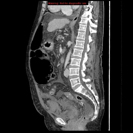 Abdominal wall hematoma (Radiopaedia 9427-10112 Sagittal C+ portal venous phase 52).jpg