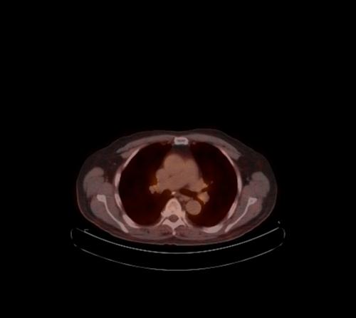 Abdominal wall metastasis from colorectal carcinoma (Radiopaedia 31016-31719 C 111).jpg
