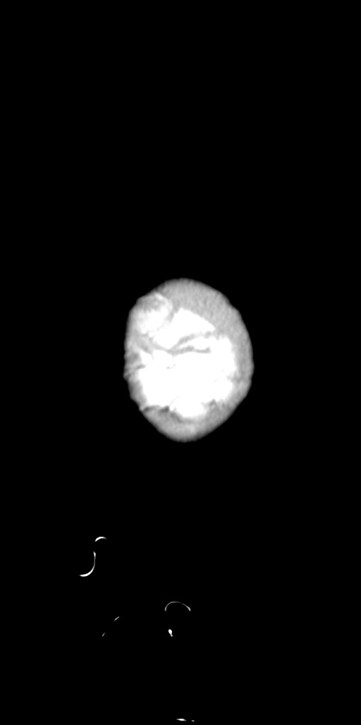 Abdominopelvic rhabdomyosarcoma (Radiopaedia 78356-90984 Sagittal C+ portal venous phase 99).jpg