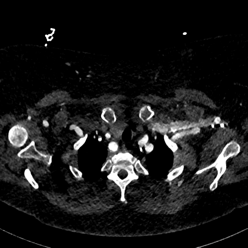 File:Aberrant right subclavian artery with Kommerell diverticulum (Radiopaedia 47982-52769 Axial C+ arterial phase 13).png