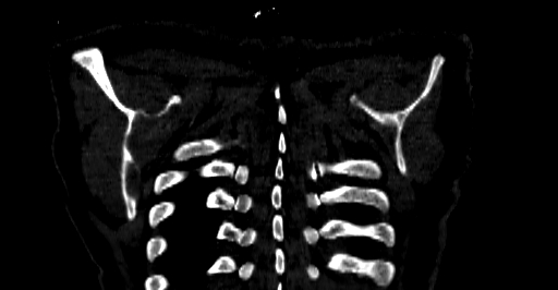 Accesory rib joint (Radiopaedia 71987-82452 Coronal bone window 83).jpg