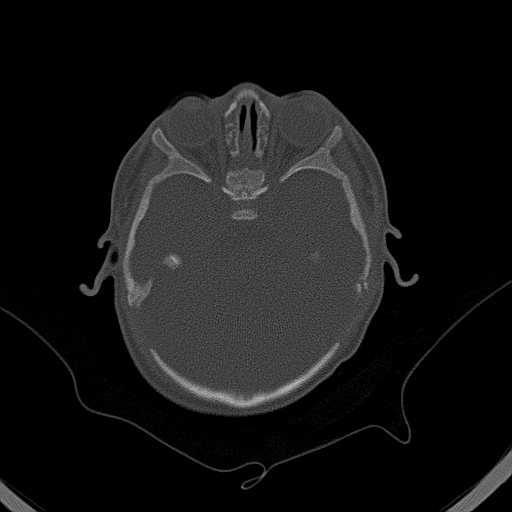 File:Accessory intraparietal suture (Radiopaedia 50584-56020 Axial bone window 10).jpg