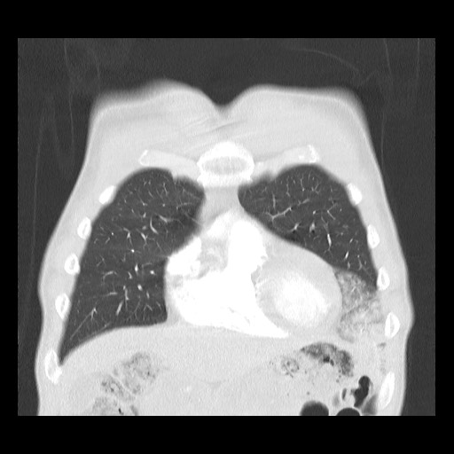 Accessory left horizontal fissure with lingular pneumonia (Radiopaedia 53763-59843 Coronal lung window 11).jpg