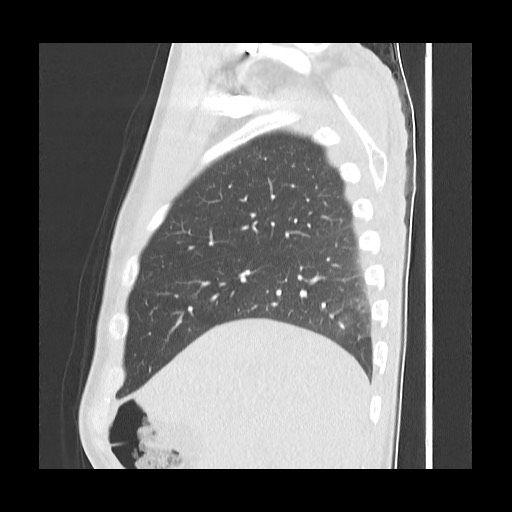 Accessory left horizontal fissure with lingular pneumonia (Radiopaedia 53763-59843 Sagittal lung window 17).jpg