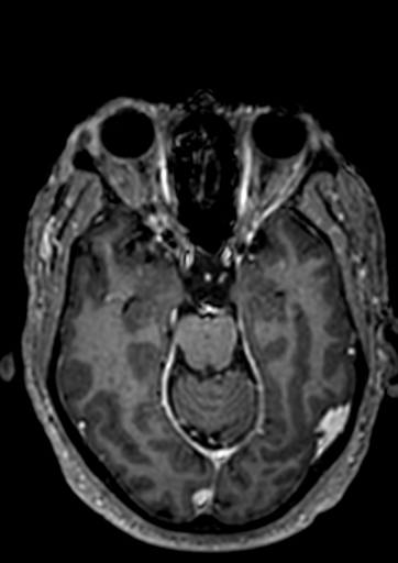 File:Accessory middle cerebral artery (Radiopaedia 73114-83828 Axial T1 C+ 85).jpg