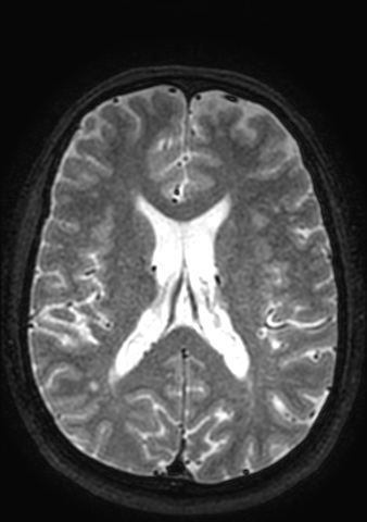 Accessory middle cerebral artery (Radiopaedia 73114-83828 Axial T2 39).jpg