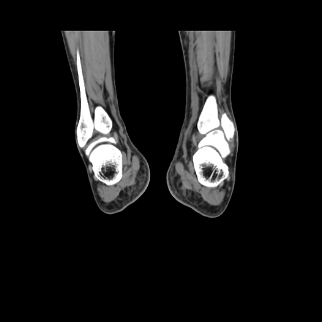 Accessory soleus muscle (Radiopaedia 61069-68943 Coronal non-contrast 52).jpg