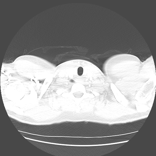 Achalasia (Radiopaedia 52507-58417 Axial lung window 2).jpg