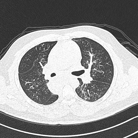 File:Achalasia with aspiration (Radiopaedia 55413-61845 Axial lung window 31).jpg