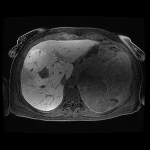 Acinar cell carcinoma of the pancreas (Radiopaedia 75442-86668 Axial late phase (~30 mins) 104).jpg