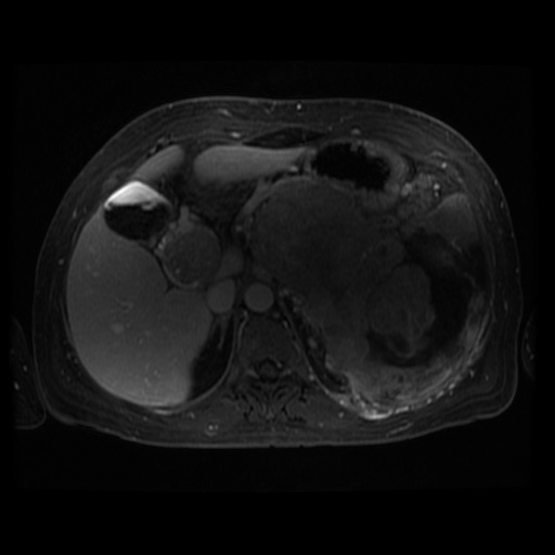 Acinar cell carcinoma of the pancreas (Radiopaedia 75442-86668 D 81).jpg