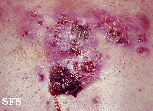 Acne Fulminans (Dermatology Atlas 2).jpg