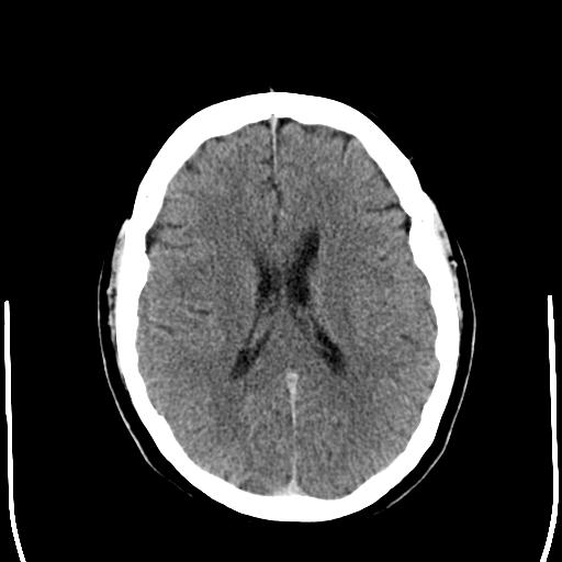 File:Acoustic schwannoma - cystic (Radiopaedia 29487-29980 AXIAL THICK non-contrast 17).jpg