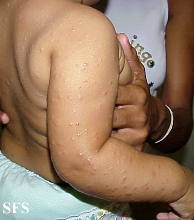 Acrodermatitis Infantile Papular (Dermatology Atlas 14).jpg