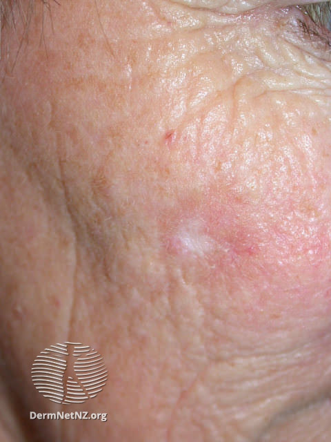 Actinic Keratoses affecting the face (DermNet NZ lesions-ak-face-387).jpg