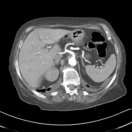 File:Active bleeding from duodenal ulcer with embolization (Radiopaedia 34216-35481 Axial C+ arterial phase 18).png