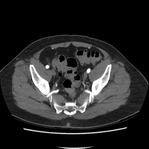 Active colonic bleed on CT (Radiopaedia 49765-55025 Axial C+ arterial phase 69).jpg
