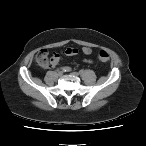 Active colonic bleed on CT (Radiopaedia 49765-55025 Axial non-contrast 59).jpg
