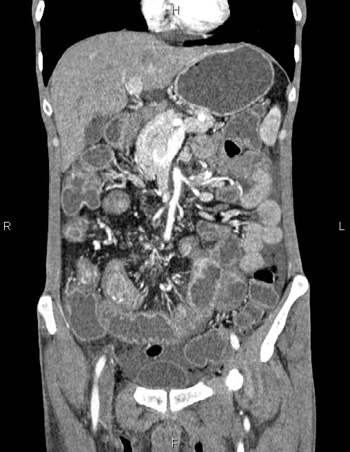 Active crohn disease (Radiopaedia 87133-103397 Coronal C+ arterial phase 23).jpg