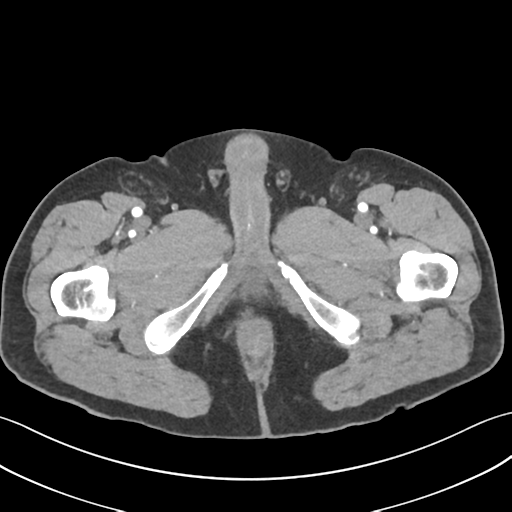 File:Active diverticular hemorrhage (Radiopaedia 39415-41725 Axial C+ arterial phase 80).png